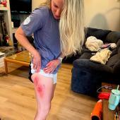 Jessica Diggins fell. © Social Media